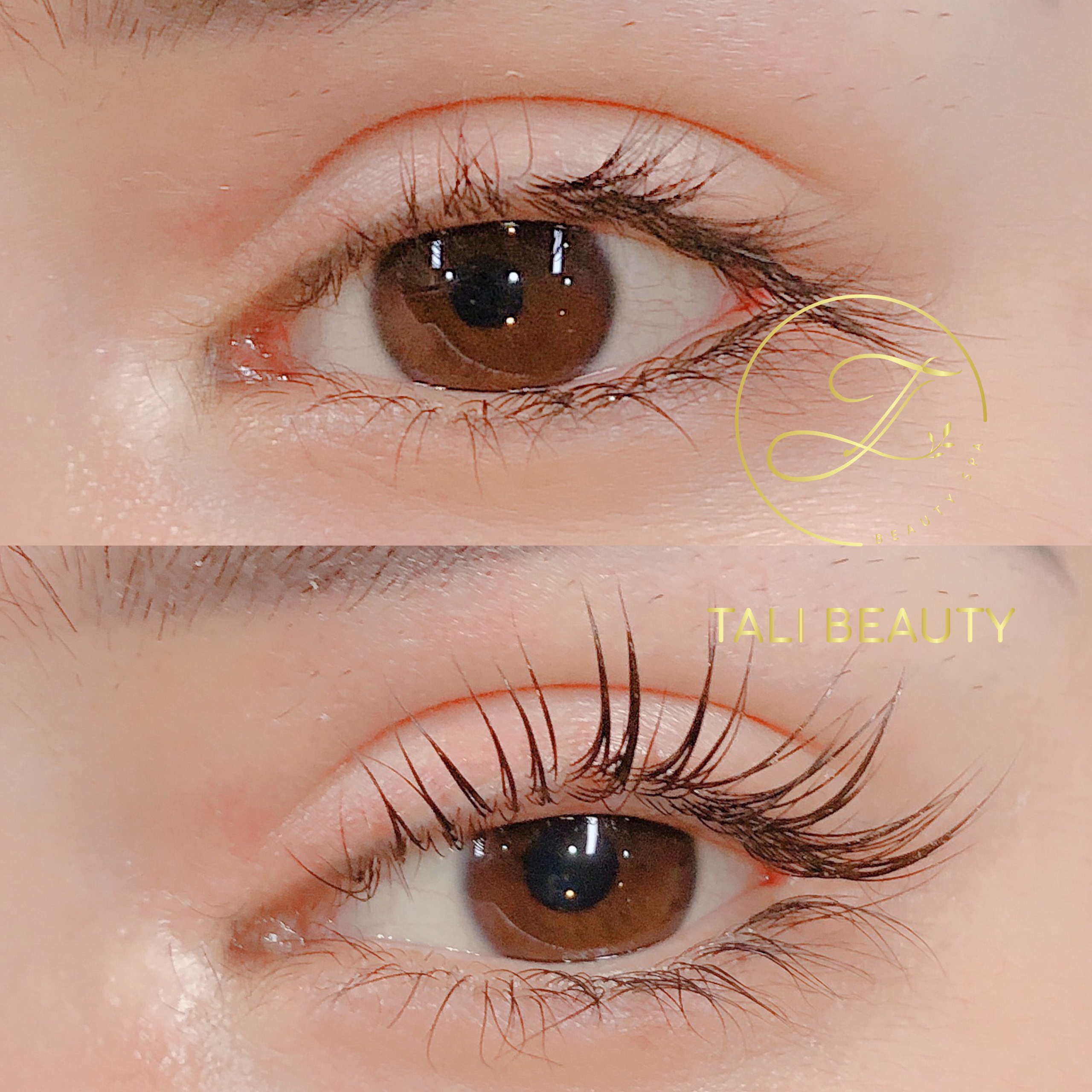 PHỤC HỒI MI HƯ TỔN - UỐN MI TRÊN