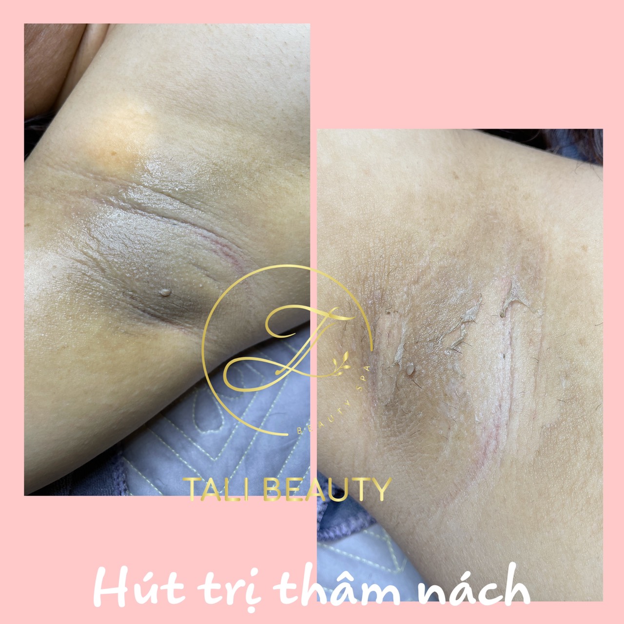 Khóa Học Trị Thâm Làm Hồng Dẫn Đầu Xu Hướng